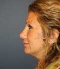 Feel Beautiful - Rhinoplasty Revision - After Photo